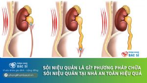 Chữa sỏi niệu quản tại nhà