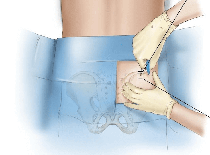 Bắt buộc phải thực hiện phương pháp xét nghiệm tủy để phân loại và xác định các loại tế bào máu trong tủy
