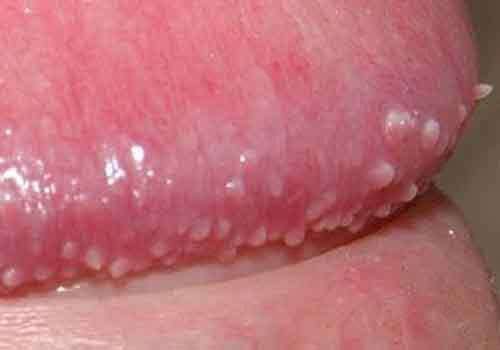 Gai sinh dục ở nam giới