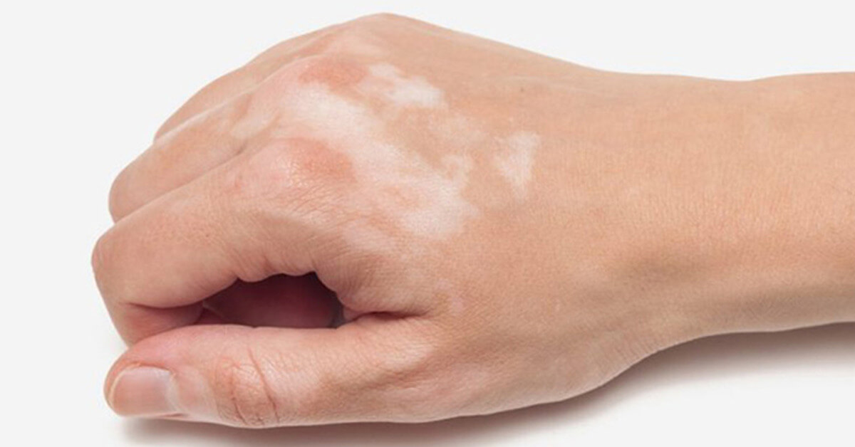 Dấu hiệu nhận biết bệnh lang ben