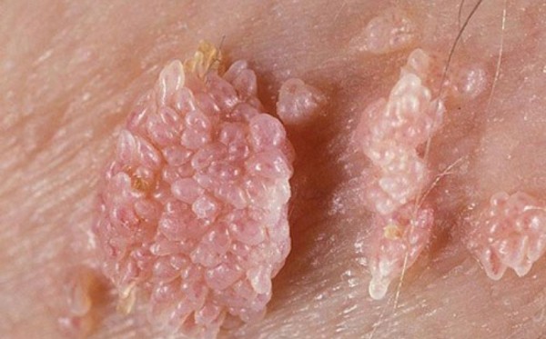 Bệnh sùi mào gà gây Nổi hạch ở vùng kín