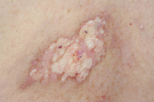 Lichen xơ hóa gây Nổi hạch ở vùng kín