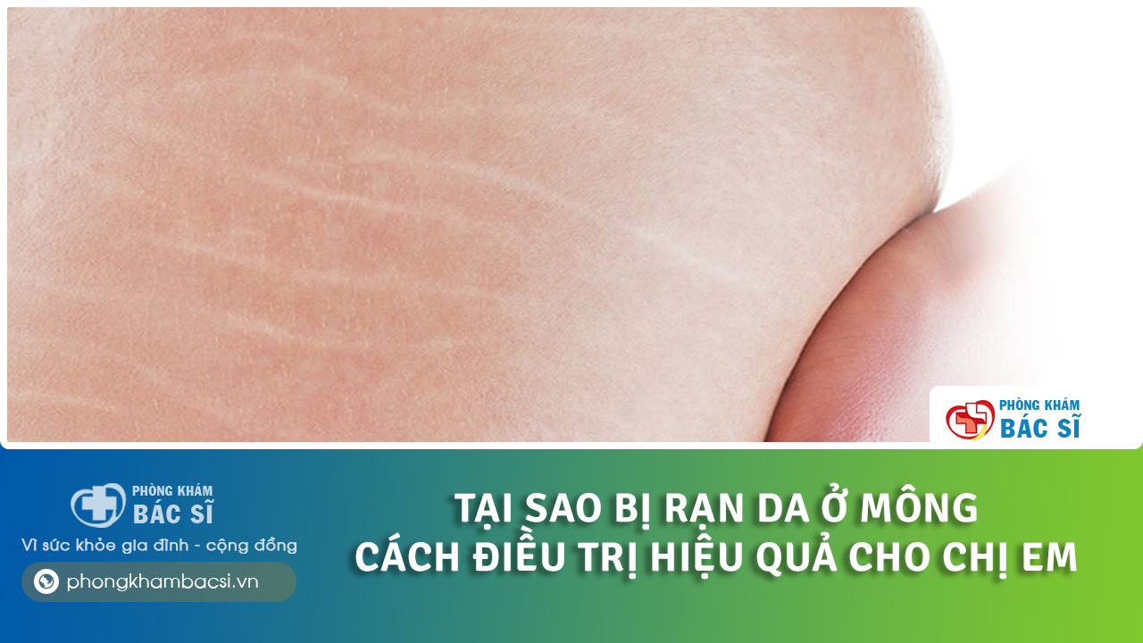 tại sao bị rạn da mông