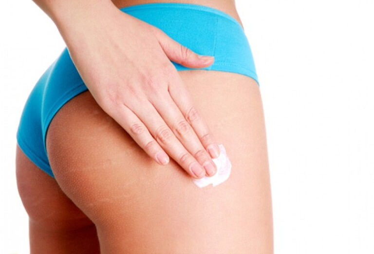 Bôi kem hoặc thuốc để điều trị rạn mông