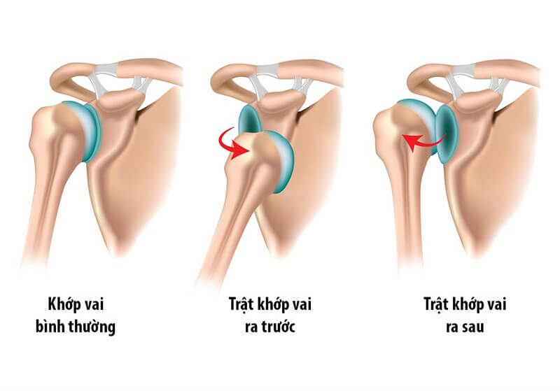 Các dạng trật khớp vai