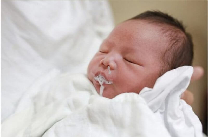Một trong những dấu hiệu của chấn động não ở trẻ sơ sinh là trẻ bị buồn nôn, ói mửa