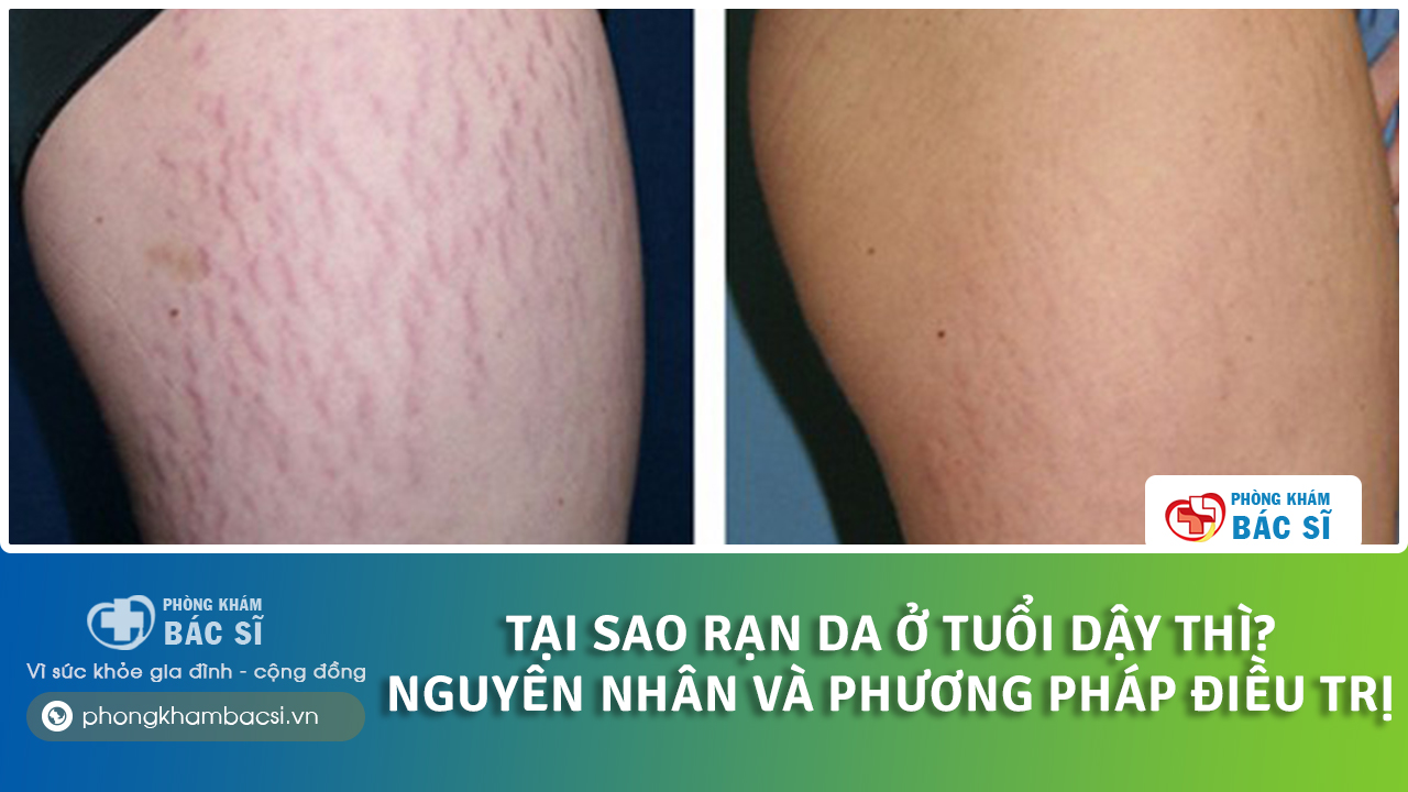 tại sao bị rạn da ở tuổi dậy thì
