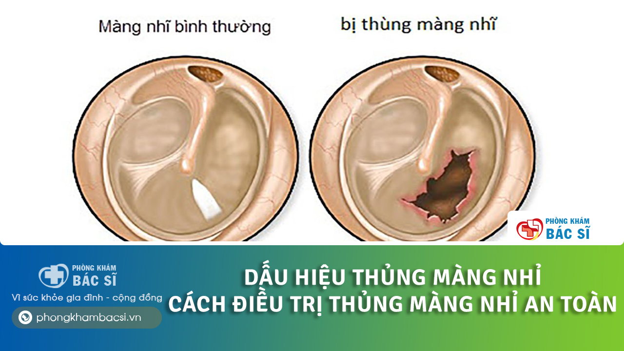 cách chữa thủng màng nhĩ tại nhà