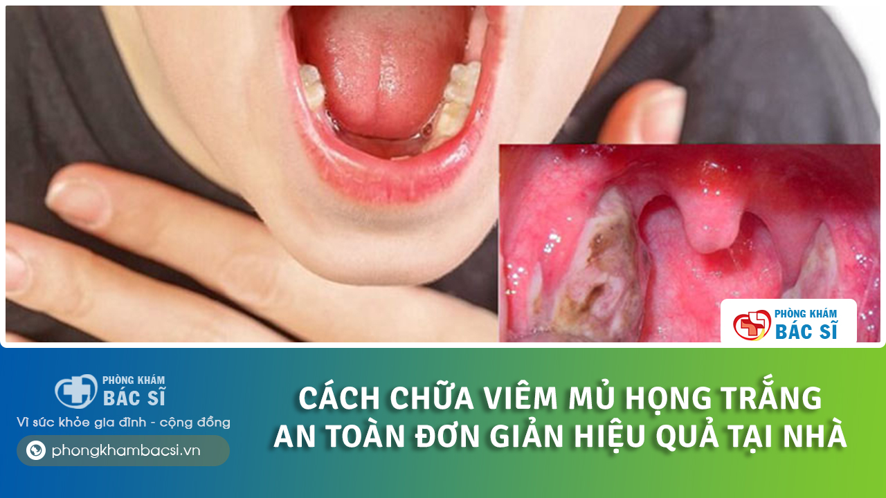 cách chữa viêm họng mủ trắng tại nhà