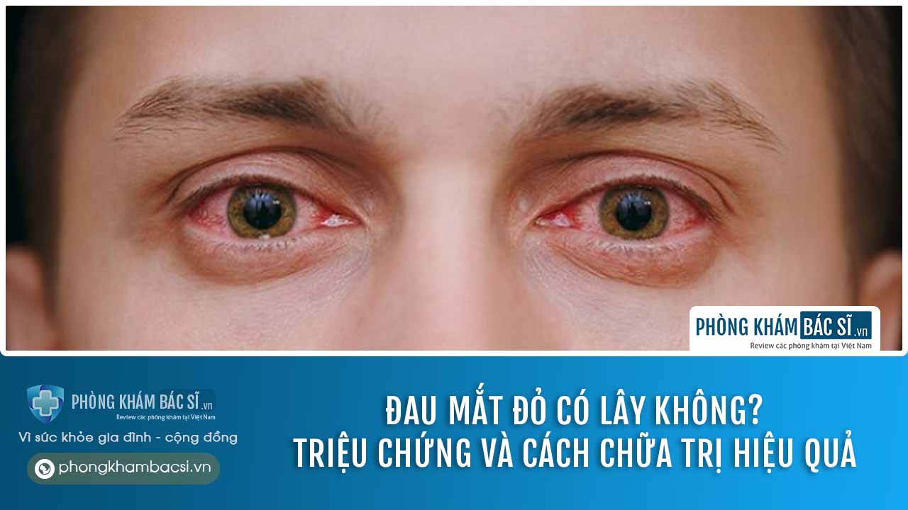 Đau mắt đỏ có lây không? Triệu chứng và cách chữa trị an toàn, hiệu quả