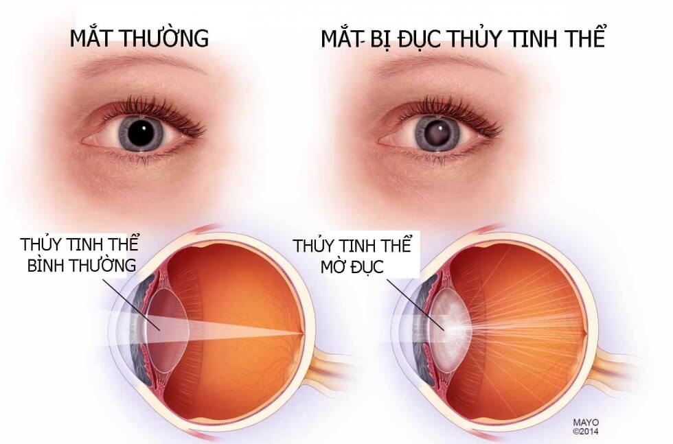 Mắt bị đục thủy tinh thể