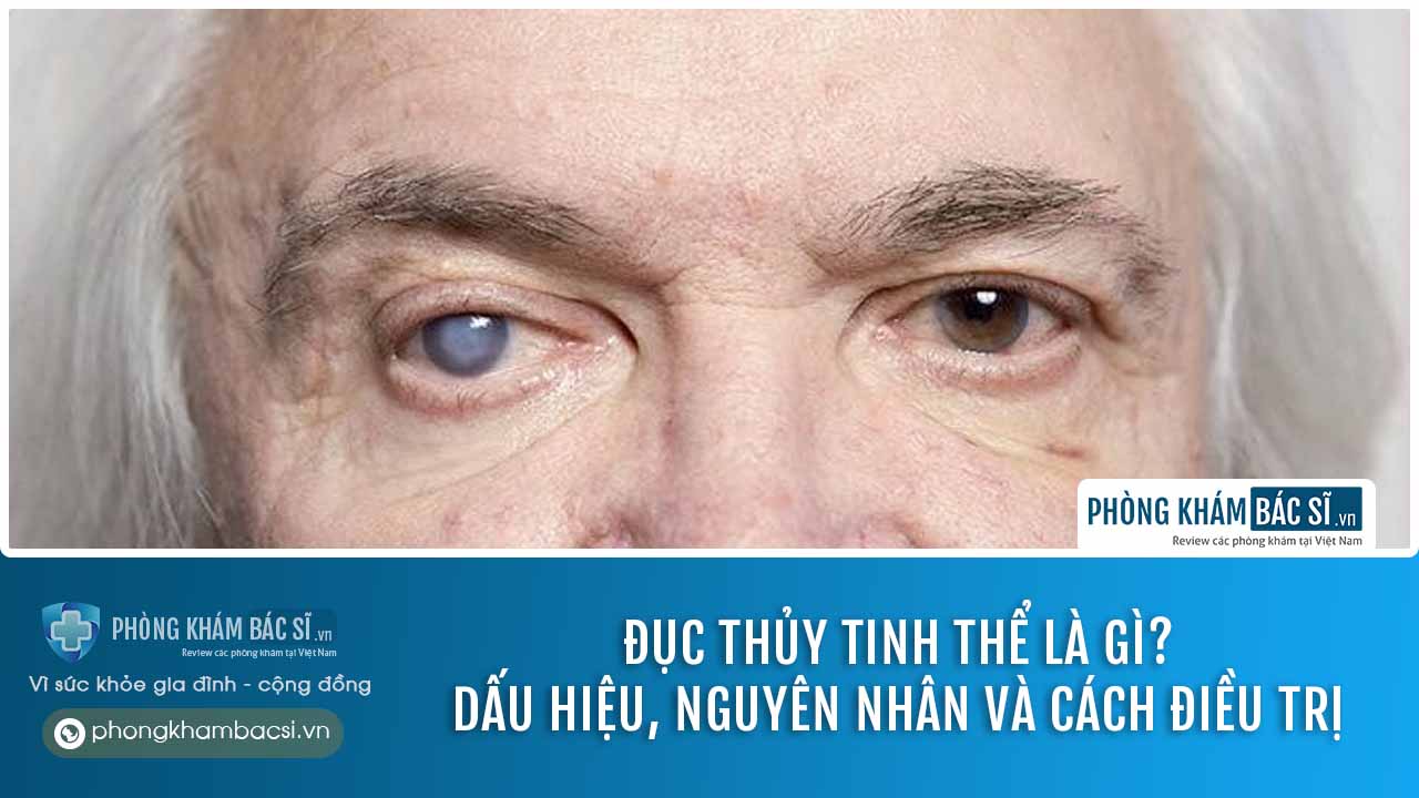 Đục thủy tinh thể là gì? Dấu hiệu, nguyên nhân và cách điều trị