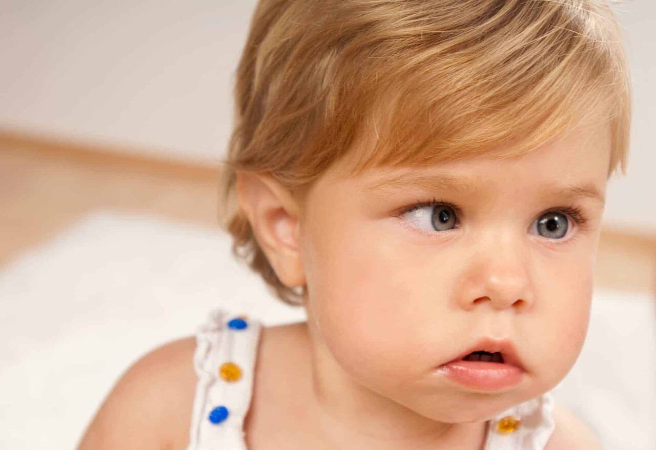 trẻ bị mắt lác