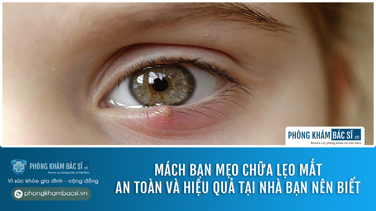 Lẹo mắt là gì? Nguyên nhân, Dấu hiệu & Cách chữa trị