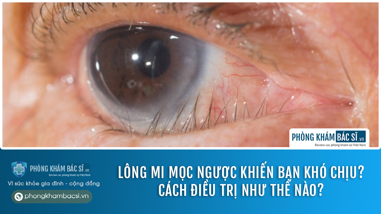 Lông mi mọc ngược có nguy hiểm không? Cách điều trị như thế nào?