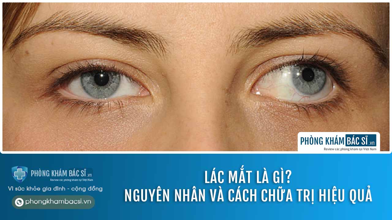 Lác mắt là gì? Nguyên nhân, dấu hiệu và cách chữa trị hiệu quả