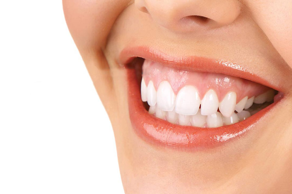 cười hở lợi là gì