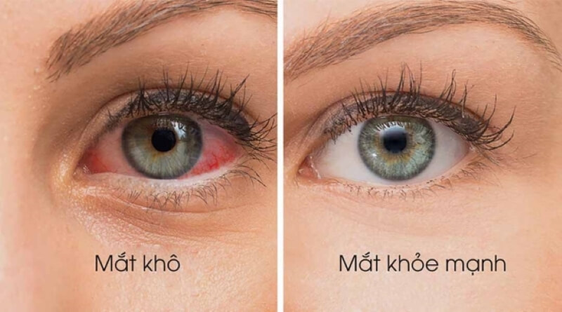 mắt bị khô và mắt bình thường