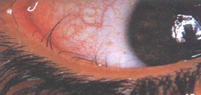 tình trạng lông mi mọc ngược