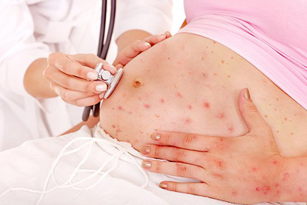 chữa trị bệnh rubella