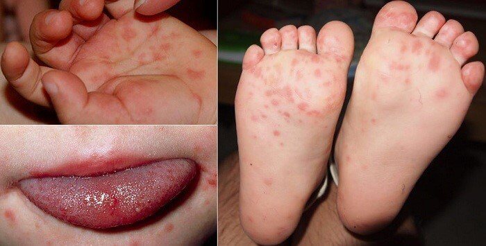 bệnh tay chân miệng ở trẻ em