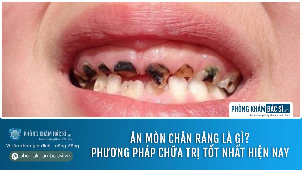 chữa trị ăn mòn chân răng