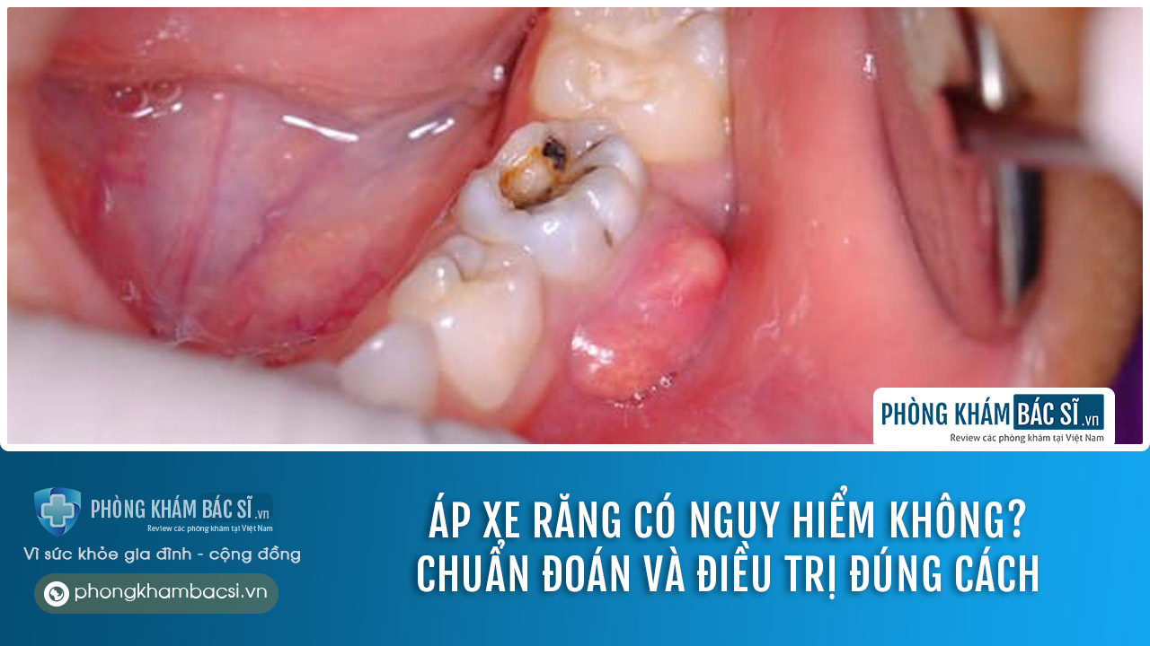 Áp xe răng là gì? Nguyên nhân, chẩn đoán và chữa trị
