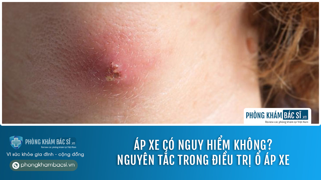 Áp xe là gì? Nguyên nhân hình thành và cách chữa trị hiệu quả