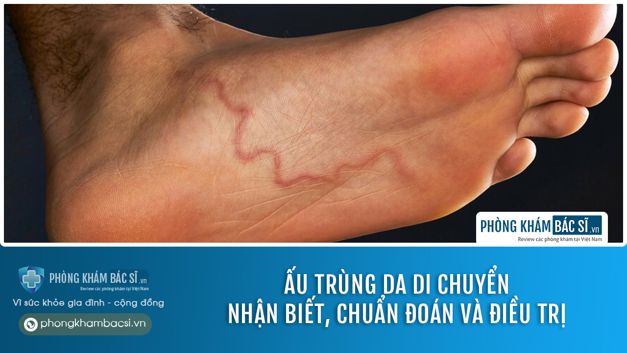 Bệnh ấu trùng da di chuyển: Nhận biết, Chẩn đoán và Chữa trị