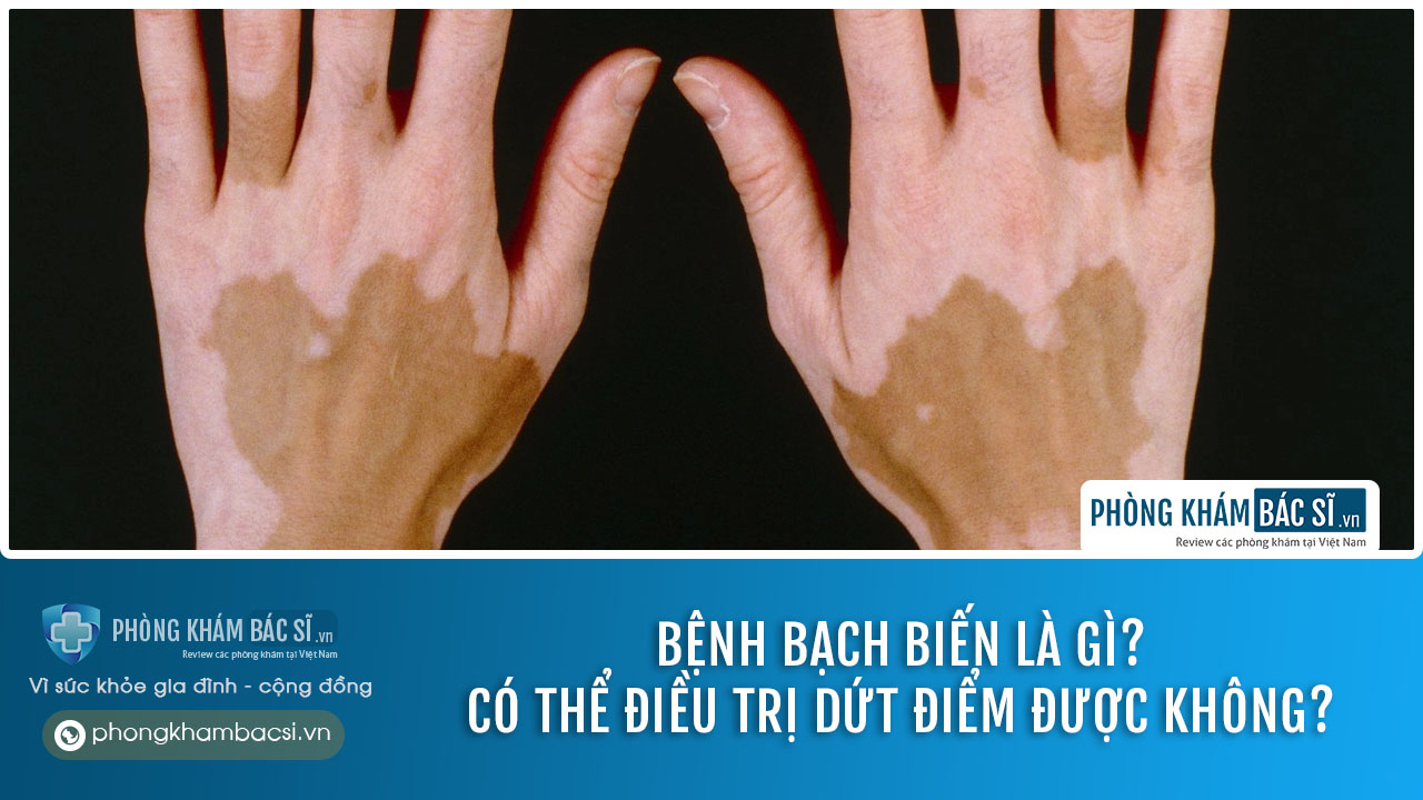 Bệnh bạch biến là gì? Nguyên nhân và phương pháp chữa trị