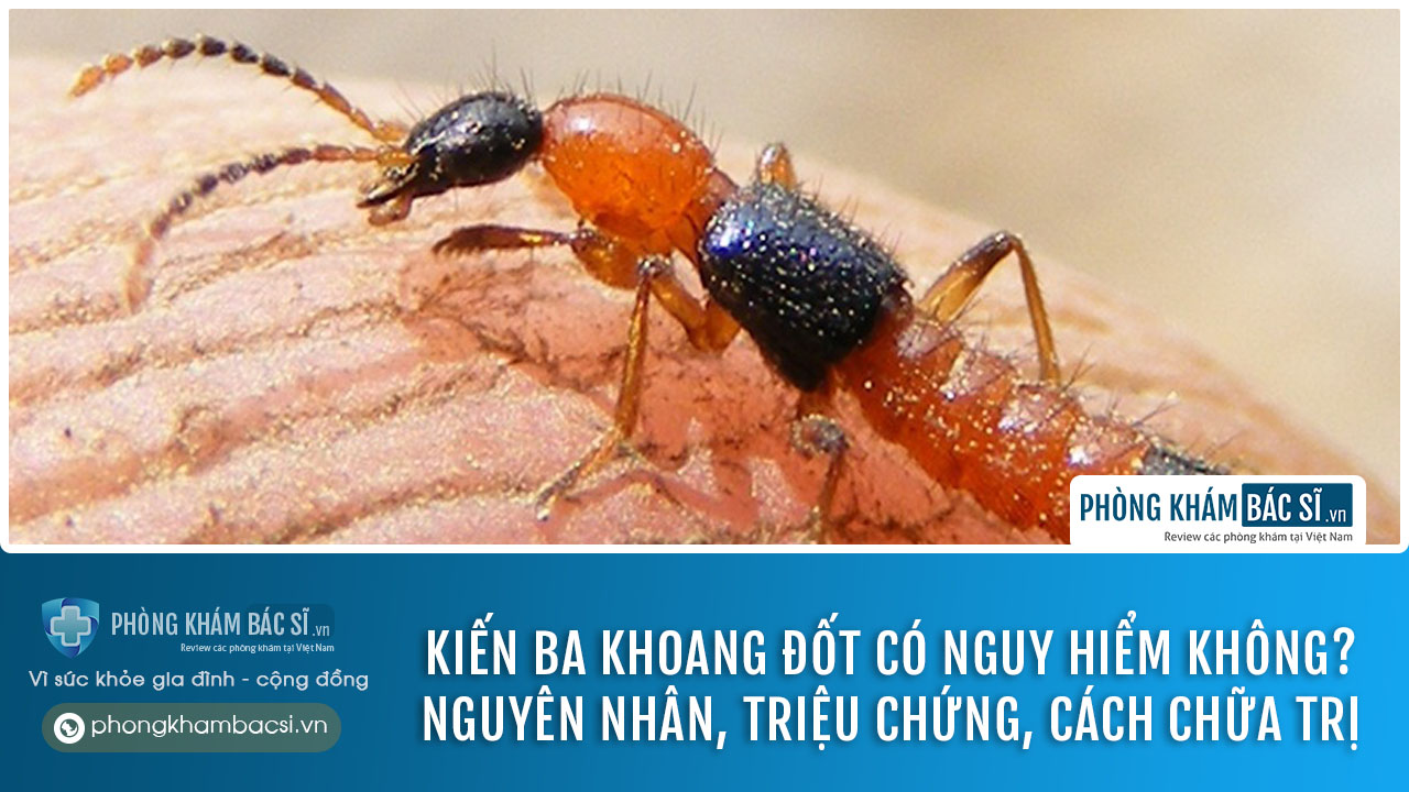 Kiến ba khoang đốt có nguy hiểm không? Nguyên nhân, triệu chứng và cách chữa trị