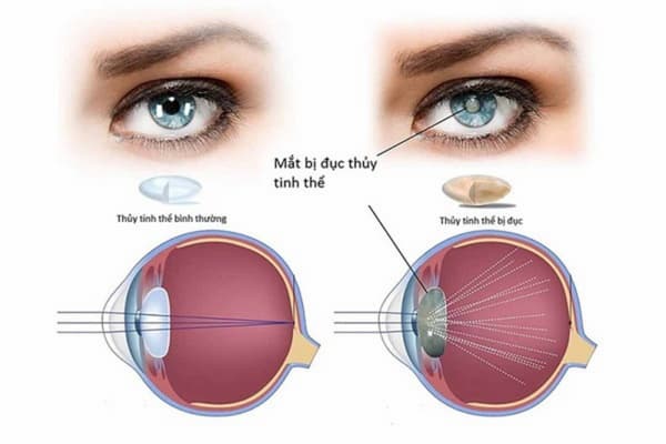Nguyên nhân mắt bị nhòe