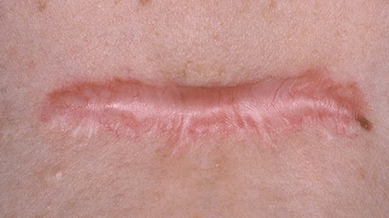 Chữa trị sẹo lồi