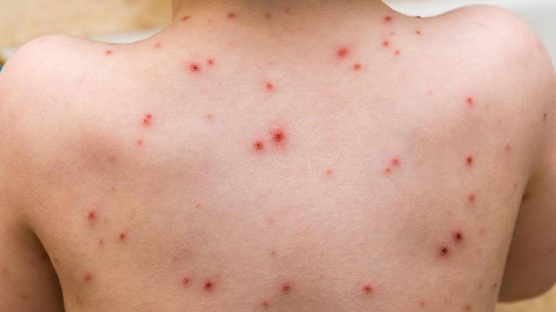 thủy đậu để lại sẹo trên da gây mất thẩm mỹ