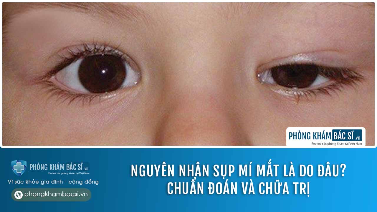 Nguyên nhân sụp mí mắt là do đâu? Chuẩn đoán và chữa trị