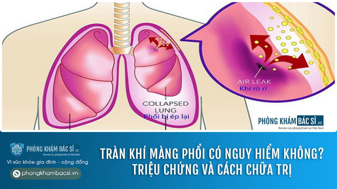 chữa trị tràn khí màn phổi