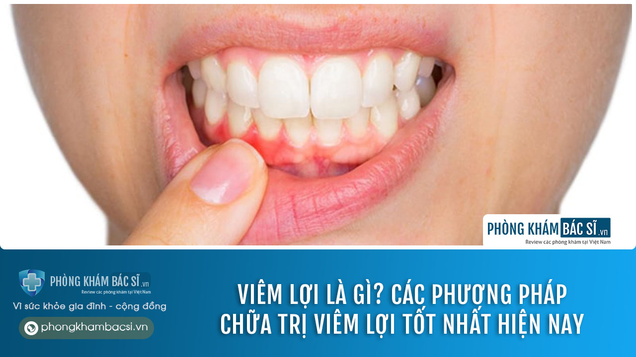 chữa trị viêm lợi