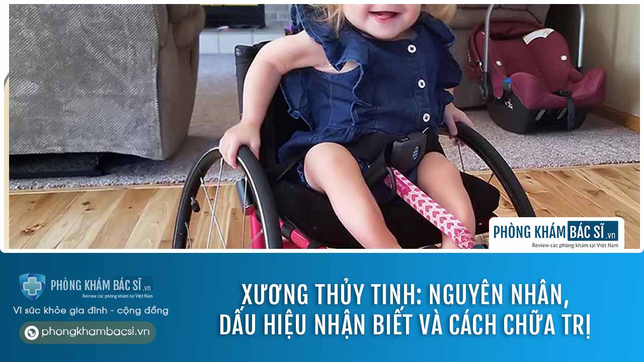 chữa trị xương thuỷ tinh
