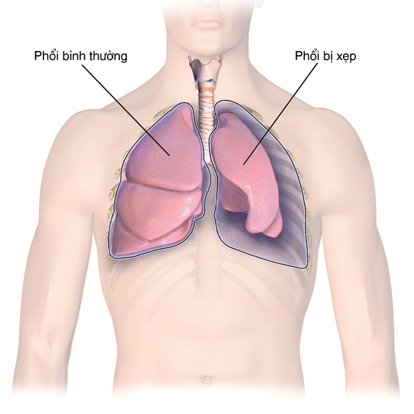 tràn khí màng phổi