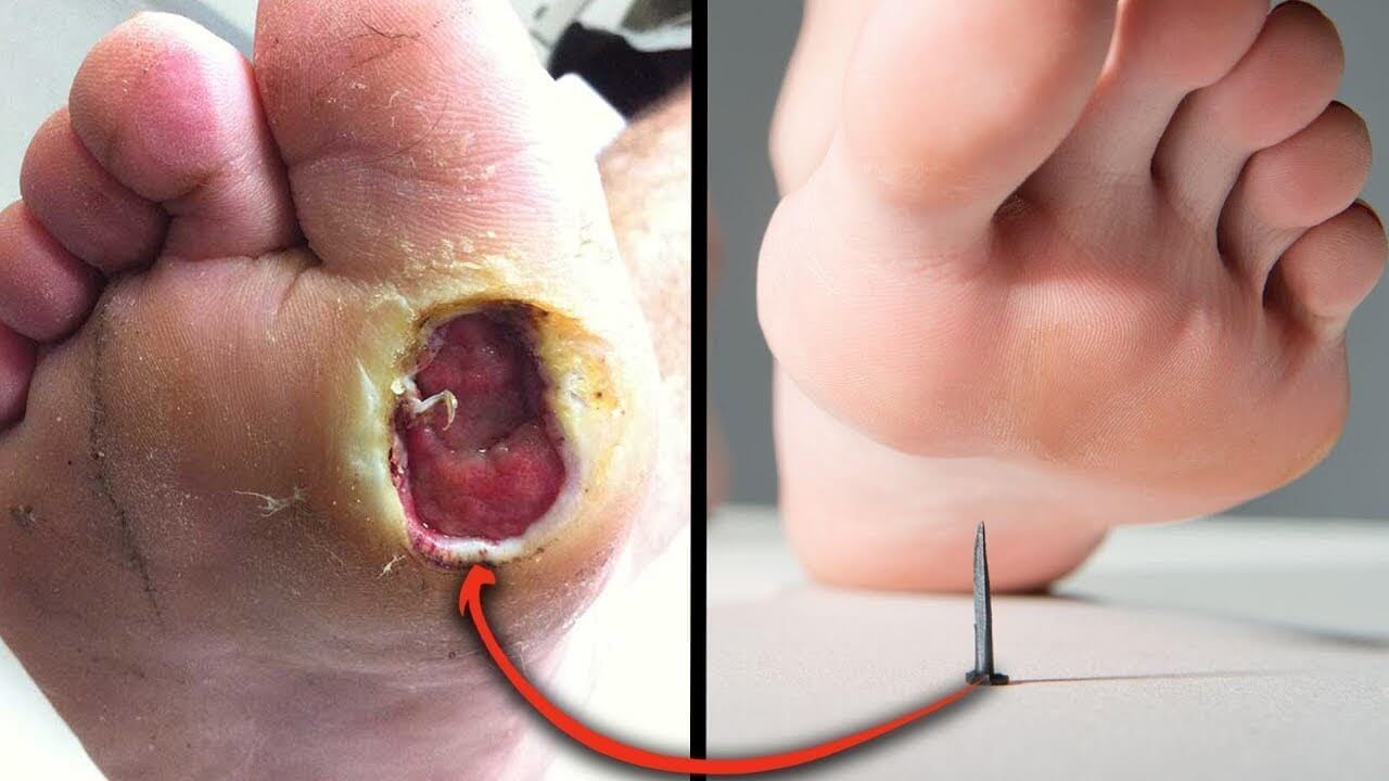 chữa trị uốn ván