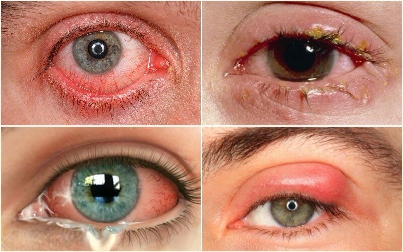 Viêm kết mạc: Nguyên nhân, Triệu chứng và Cách chữa trị