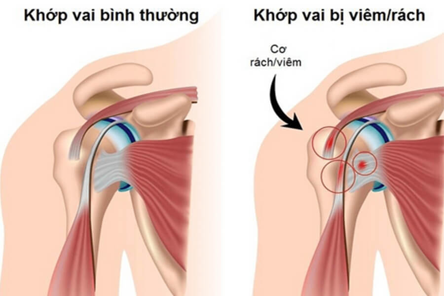 Bệnh viêm khớp vai