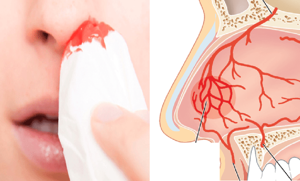 Chảy máu cam: Nguyên nhân, Triệu chứng và Phương pháp chữa trị