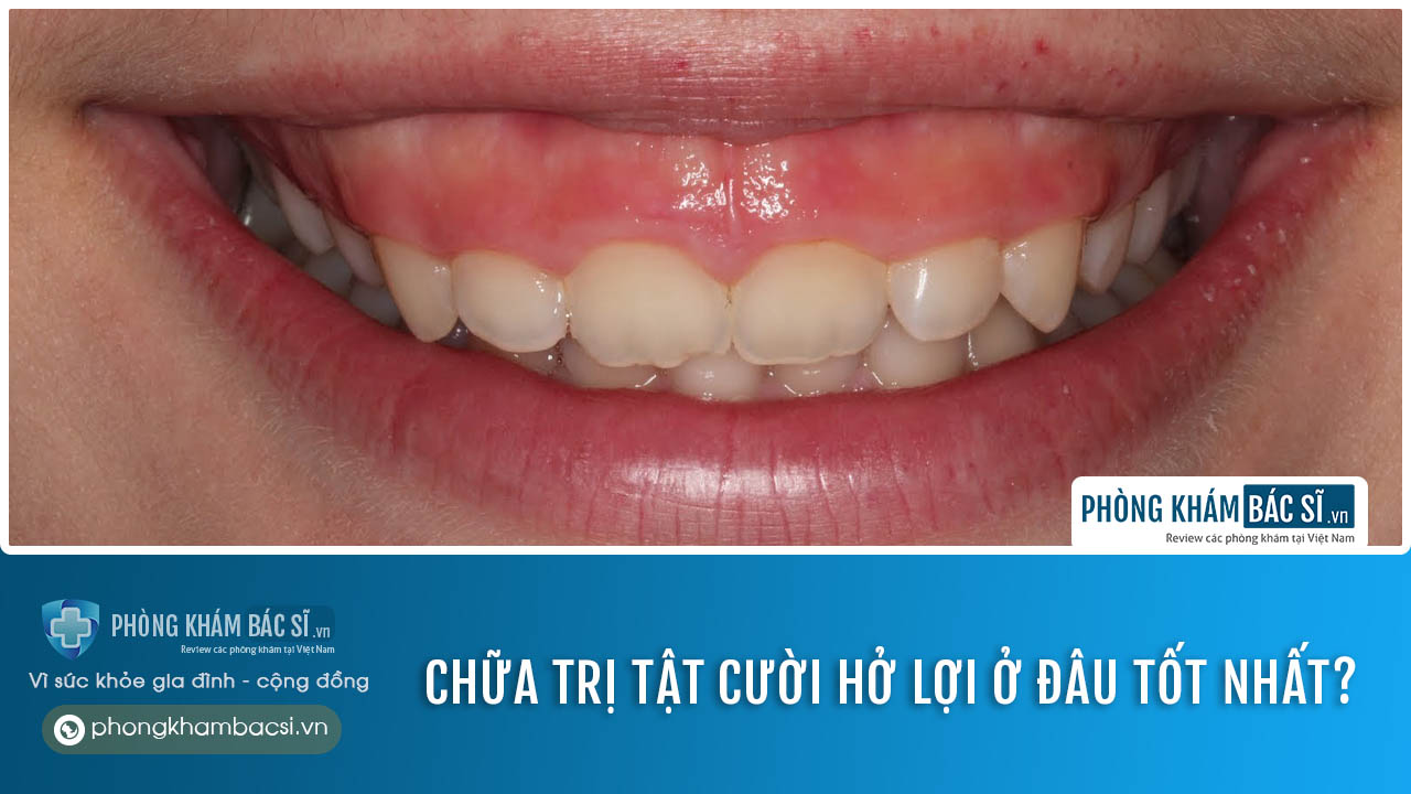 Chữa trị tật cười hở lợi ở đâu tốt nhất?