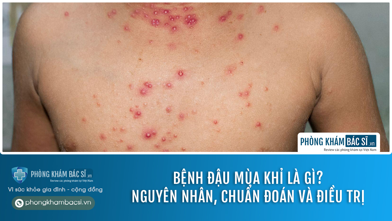 Bệnh đậu mùa khỉ là gì? Nguyên nhân, chuẩn đoán và chữa trị
