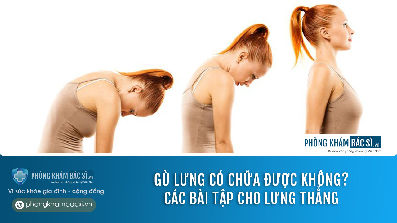 Gù lưng có chữa trị được tại nhà hay không? Các bài tập cho lưng thẳng