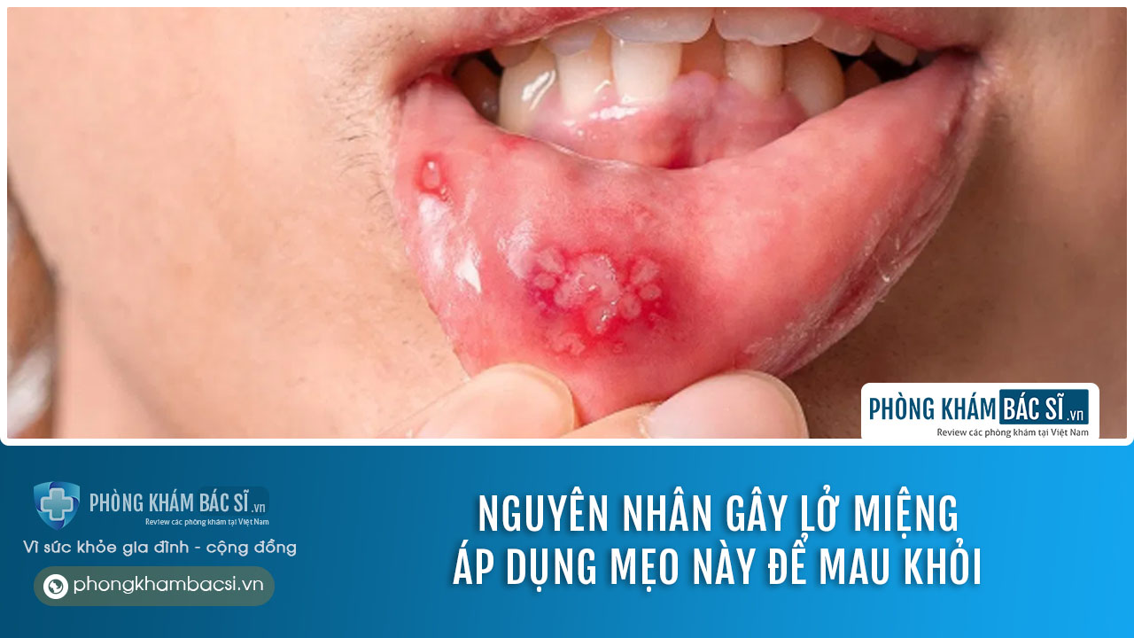Lở miệng: Nguyên nhân, Triệu chứng và Phương pháp chữa trị