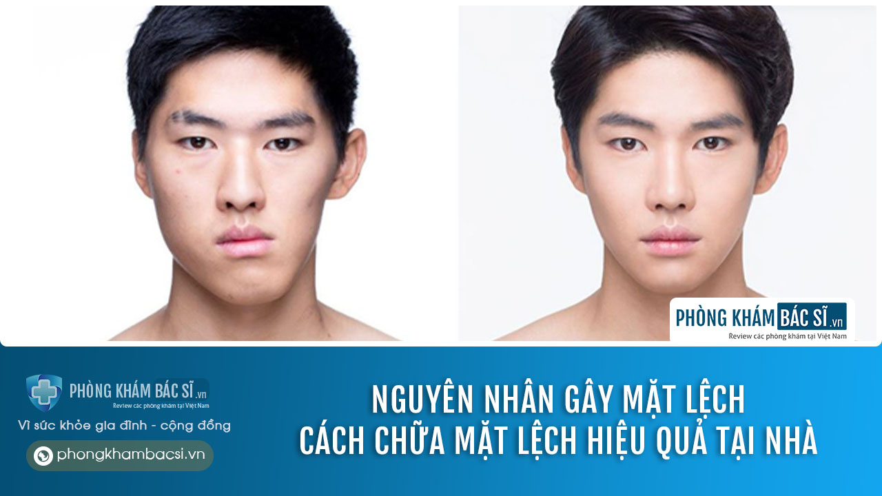 Mặt lệch: Nguyên nhân do đâu? Cách chữa trị hiệu quả tại nhà