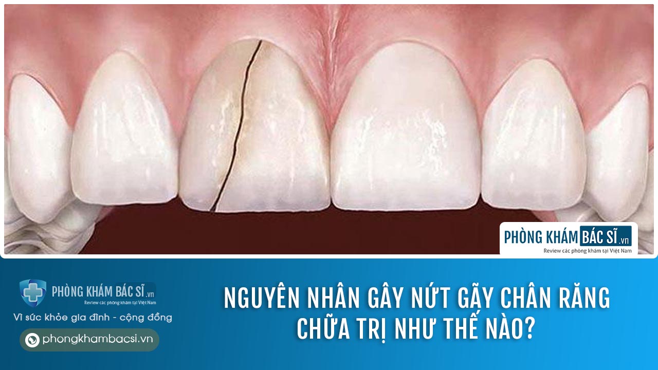 Nguyên nhân gây nứt gãy chân răng. Chữa trị như thế nào?
