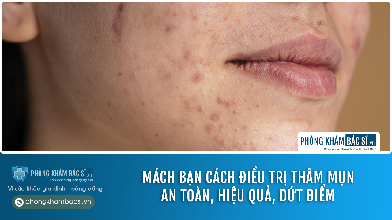 Mách bạn cách điều trị thâm mụn an toàn và hiệu quả